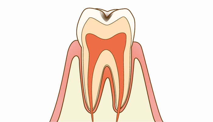 C1：エナメル質の虫歯