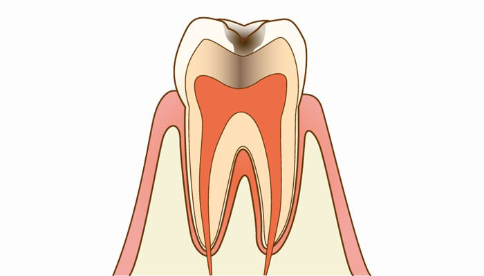 C2：象牙質の虫歯