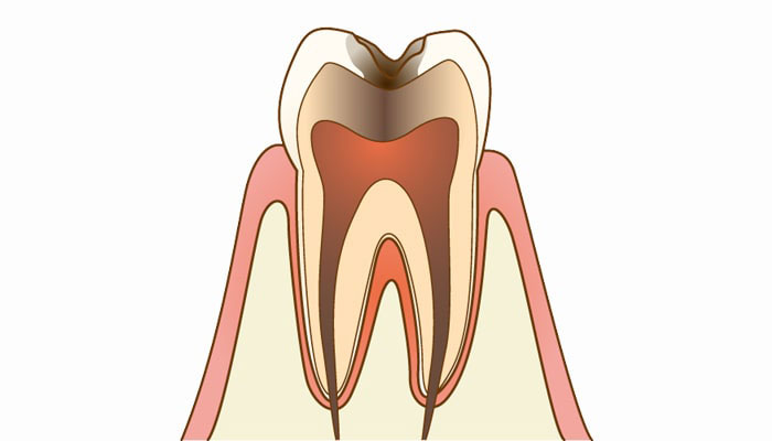C3：神経まで達した虫歯