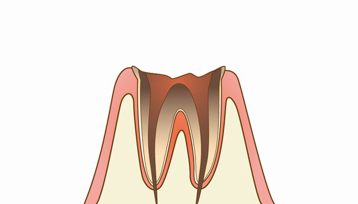 C4：歯根まで達した虫歯