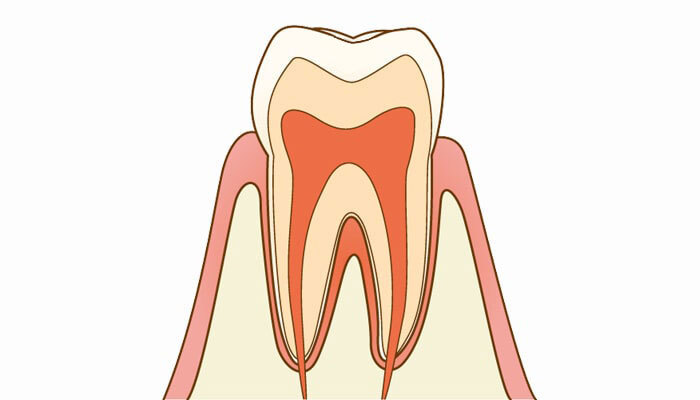 C0：ごく初期の虫歯