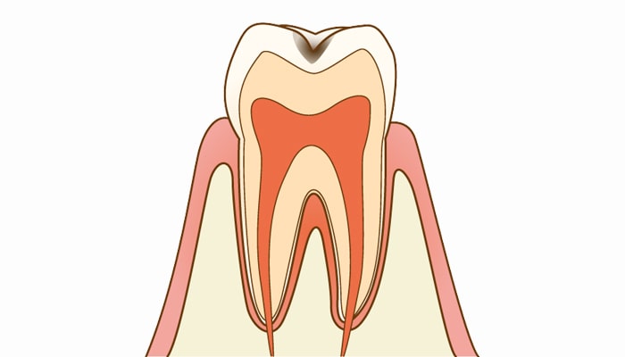 C1：エナメル質内の虫歯