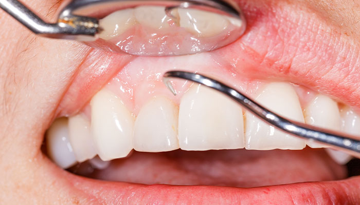 歯石や歯垢（プラーク）除去