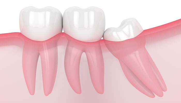 歯根の吸収が生じる